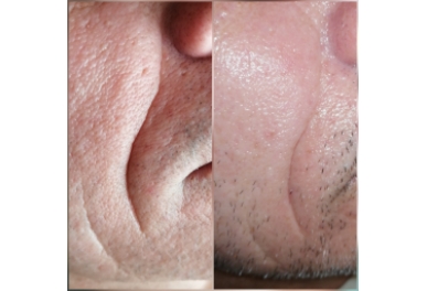  Zabieg DermaOrganic AT Revital  Zabieg liftingujący na twarz z użyciem Dermation i koktajlu T-derm Series Revital.