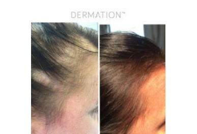  Zabieg DermaOrganic AT Hair-revital​  Zabieg na porost włosów z użyciem Dermation i koktajlu T-derm Series Hair-Revital.