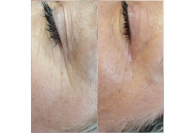  Zabieg DermaOrganic AT Revital + Peptide  Zabieg liftingujący na twarz z użyciem Dermation i koktajlu T-derm Series Revital z dodatkiem Advanced Anti-Aging Peptide.