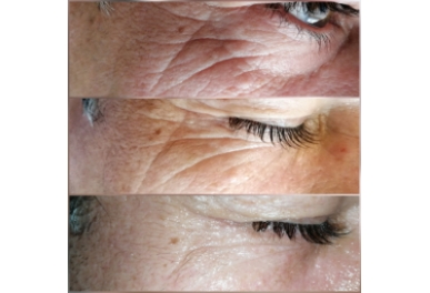  Zabieg DermaOrganic AT Revital  Zabieg liftingujący na twarz z użyciem Dermation i koktajlu T-derm Series Revital.