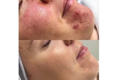  Zabieg DermaOrganic AT Acne  Zabieg przeciwtrądzikowy na twarz z użyciem Dermation i koktajlu T-derm Series Acne.